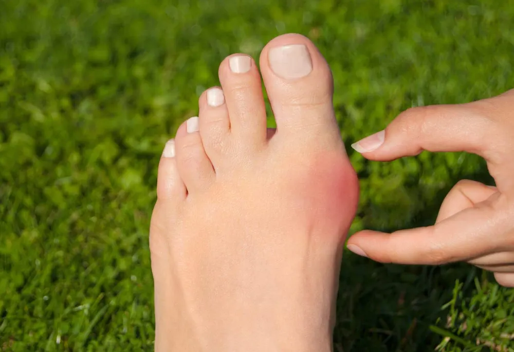 Como prevenir joanete: cuide dos pés mesmo com herança